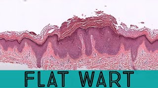 Flat wart under the microscope verruca plana pathology dermpath dermatology dermatopathology [upl. by Manon341]