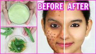 Remove Pimples Permanently 100 Results  DIY Face Wash Spot Treatment  Anaysa [upl. by Felecia710]