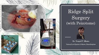 Ridge Split Surgery with Peizotome [upl. by Marieann108]