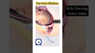 Cervical dilation procedure anatomy obg [upl. by Griffin]