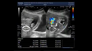 Ultrasound Video showing Fetal demise in the first trimester [upl. by Ayenat]