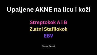 Upaljene AKNE na licu i koži  Denis Beroš [upl. by Afrikah850]