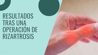 👍🏻 Resultados tras una Operación de Rizartrosis del pulgar  Dr Sánchez Angulo [upl. by Areval44]