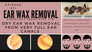 DRY EAR WAX REMOVAL FROM VERY FULL EAR CANALS EP 371 [upl. by Nimrac33]