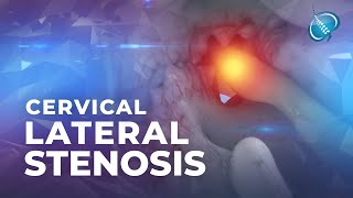 What is Cervical Lateral Stenosis  Foraminal Stenosis [upl. by Peacock783]