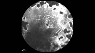 RealTime Fluorescein Angiography [upl. by Teryl]