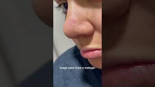 Parches para acné acne skincare tipsdeskincare [upl. by Jacobsohn]