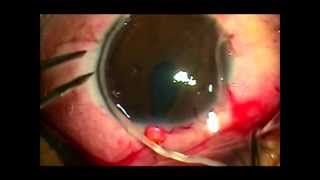 Man with Parasite Worm in Eye  Nematode Worms in Eyeball [upl. by Rosdniw]