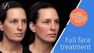 Full Face Dermal Fillers Treatment Demonstration by Dr Tristan Mehta [upl. by Erdrich]