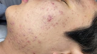 ACNE TREATMENT VU QUYNH MI  Blackheads On Boy Face 2024FULL [upl. by Aloap789]