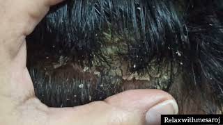 BIG DANDRUFF FLAKES  Scalp Scratching and Satisfying Dandruff Removal [upl. by Nailij]