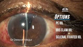 Secondary IOL implantation in an aphakic eye with PC tear amp vitreous prolapse Dr Deepak Megur [upl. by Reich447]