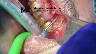 surgical extraction of buccal impacted upper wisdom very difficult case [upl. by Anehsuc]