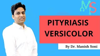 Pityriasis Versicolor By Dr Manish Soni  Dermatology [upl. by Chard273]