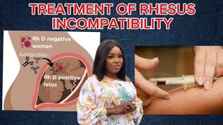 Treatment of Rhesus incompatibility [upl. by Berners382]