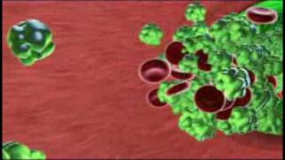 Hypoparathyroidism [upl. by Hardi]