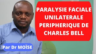 Paralysie faciale périphérique unilatérale à frigoré de Charles Bell [upl. by Ibed]