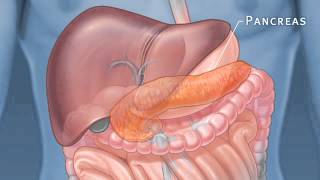 Pancreatic Auto Islet Transplantation with Total Pancreatectomy [upl. by Alleacim703]