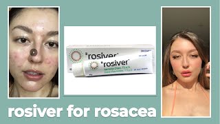 Rosiver Ivermectin Cream For Rosacea Review [upl. by Ataymik]