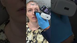 Dissolving Tear Trough Filler  Dr Medispa [upl. by Liamsi]