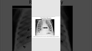 Rachitic rosaryricketsradiology neetpg [upl. by Schoenfelder615]