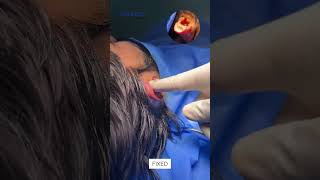 Otoplasty  Ear Correction  Cosmetico by Dr Kamal [upl. by Airetnuhs]