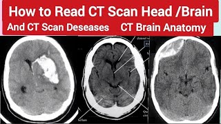 How to read CT Scan Head  Brain  CT Scan Brain Diseases  ctscan CTBrain ct Radiography [upl. by Lough382]