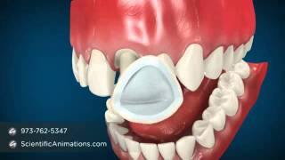 Dental Cap Procedure  Tooth Caps [upl. by Mobley]