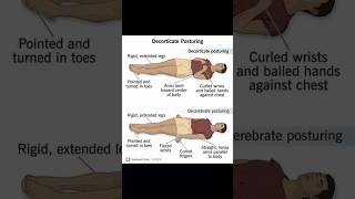 Decorticate posturing and Decerebrate posturing  important for bpt👀☠️📝 [upl. by Assenab]