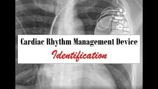 Cardiac Rhythm Management Device Identification [upl. by English]