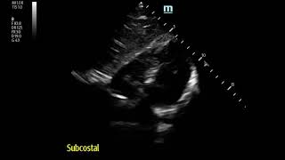 Severe Pleuritic MidChest Pain in 17 yo Boy Pneumomediastinum [upl. by Refeinnej]