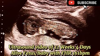 Ultrasound video of 12 Weeks 4 Days Alive FetusBaby with FHR 161bpm [upl. by Aniad]