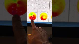 Athens Protocol for post LASIK ectasia and keratoconus 10 years on Kanellopoulos MD [upl. by Alleen]