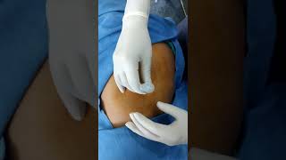 Trochanteric Bursitis Injection Depomedrol [upl. by Adranoel578]