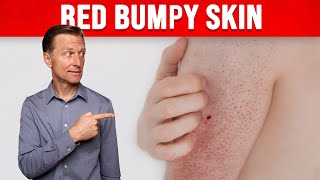 1 Perfect Remedy for Keratosis Pilaris CHICKEN SKIN [upl. by Ahseyd29]