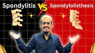 spondylitis vs spondylolisthesis  spondylitis  Spondylolisthesis  everything you need to know [upl. by Annabell]