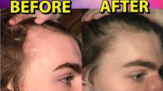 HYPERRESPONDER To Minoxidil REVERSES Hair Loss In 3 Months and Obtains FEMININE Hairline [upl. by Minier]