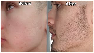 Minoxidil Beard Growth  3 Month Transformation  BEFORE and AFTER [upl. by Sorgalim]