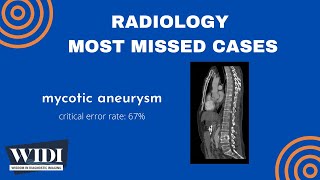 Most Missed Cases Mycotic Aneurysm [upl. by Eidassac]