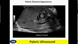 Pyloric ultrasound [upl. by Vivianne25]