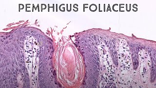 Pemphigus foliaceus autoimmune skin blister immunobullous disease in pemphigus vulgaris family [upl. by Adirf]