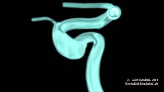 Flow instabilities in the carotid siphon [upl. by Nayra918]