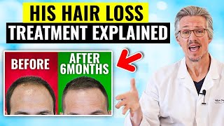 MUST SEE HAIR LOSS TURNAROUND IN JUST 6 MONTHS HOW MENS HAIR LOSS TREATMENT EXPLAINED [upl. by Sirod]