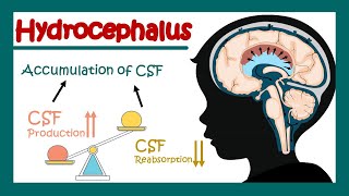 Hydrocephalus  What can cause hydrocephalus  Communicating vs non communicating hydrocephalus [upl. by Concepcion206]