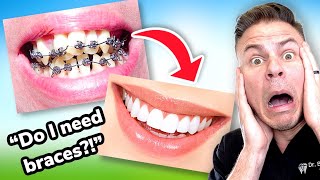 How To Tell If You Need BRACES The ULTIMATE Braces Guide Ep 1 [upl. by Nerissa612]