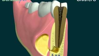 Ascesso la terapia endodontica [upl. by Niwdla]