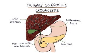 Primary Sclerosing Cholangitis Visual Explanation for Students [upl. by Berton]