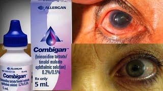 Combigan Eye Drop For Ocular Hypertension glaucoma  Brimonidine  Timolo [upl. by Ellednahs]