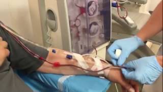 Dialysis connection of a patient with an arteriovenous fistula [upl. by Asirac799]