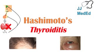 Hashimoto’s thyroiditis What Is It Whos At Risk and What You NEED to Know [upl. by Rocher]